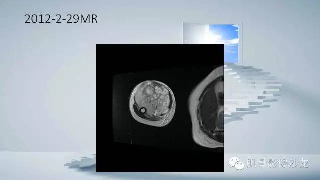 【病例】恶性外周神经鞘瘤2例MR影像表现