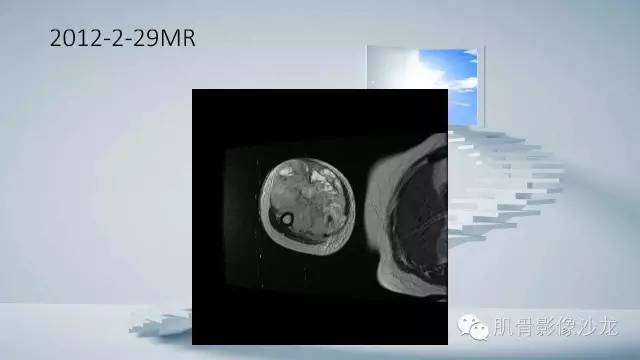 【病例】恶性外周神经鞘瘤2例MR影像表现