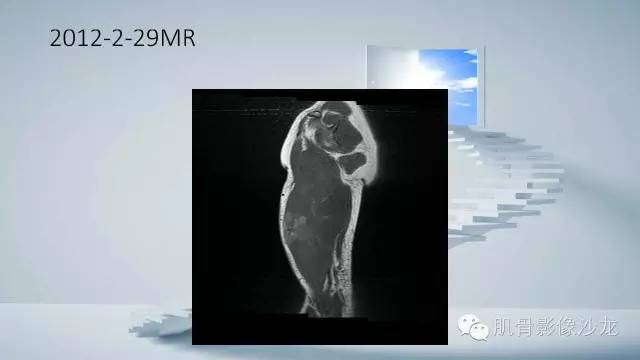 【病例】恶性外周神经鞘瘤2例MR影像表现