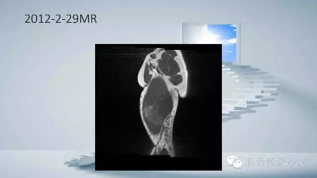 【病例】恶性外周神经鞘瘤2例MR影像表现