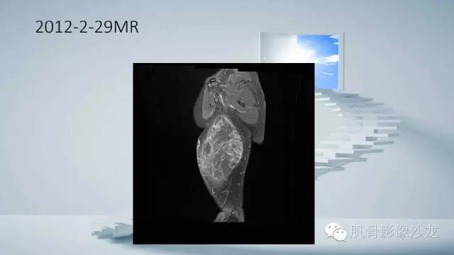 【病例】恶性外周神经鞘瘤2例MR影像表现