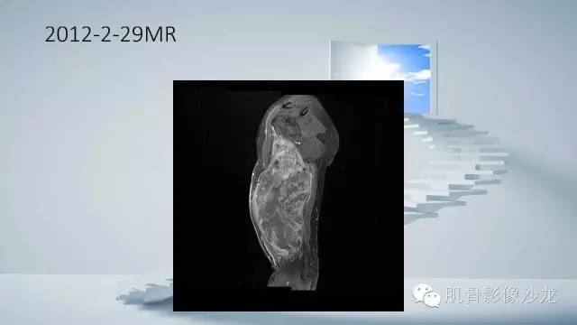 【病例】恶性外周神经鞘瘤2例MR影像表现