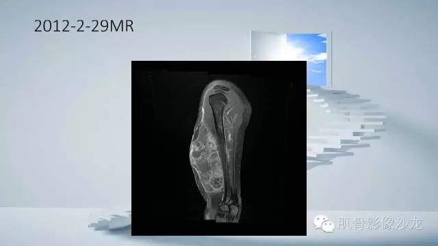 【病例】恶性外周神经鞘瘤2例MR影像表现