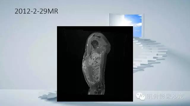 【病例】恶性外周神经鞘瘤2例MR影像表现