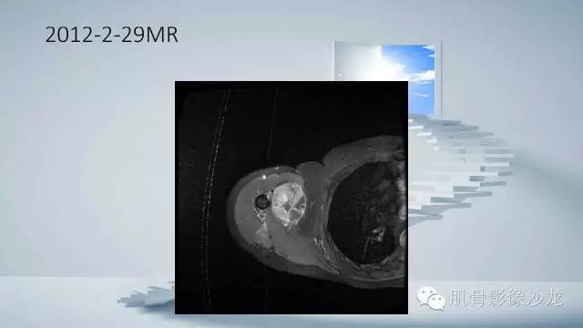 【病例】恶性外周神经鞘瘤2例MR影像表现