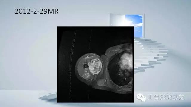 【病例】恶性外周神经鞘瘤2例MR影像表现