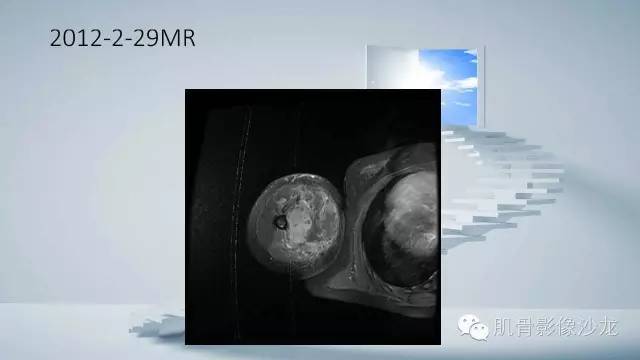 【病例】恶性外周神经鞘瘤2例MR影像表现