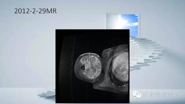 【病例】恶性外周神经鞘瘤2例MR影像表现