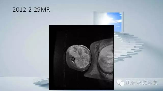 【病例】恶性外周神经鞘瘤2例MR影像表现
