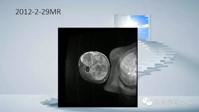 【病例】恶性外周神经鞘瘤2例MR影像表现