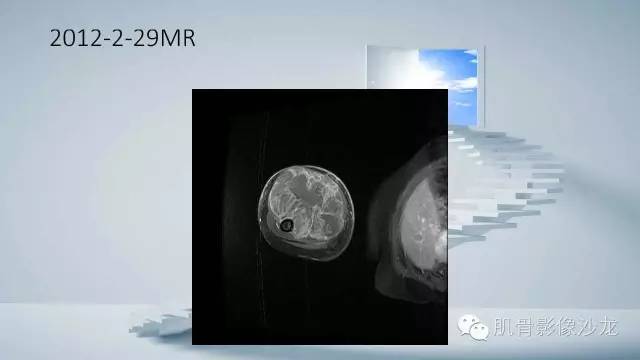 【病例】恶性外周神经鞘瘤2例MR影像表现