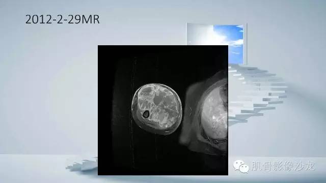 【病例】恶性外周神经鞘瘤2例MR影像表现