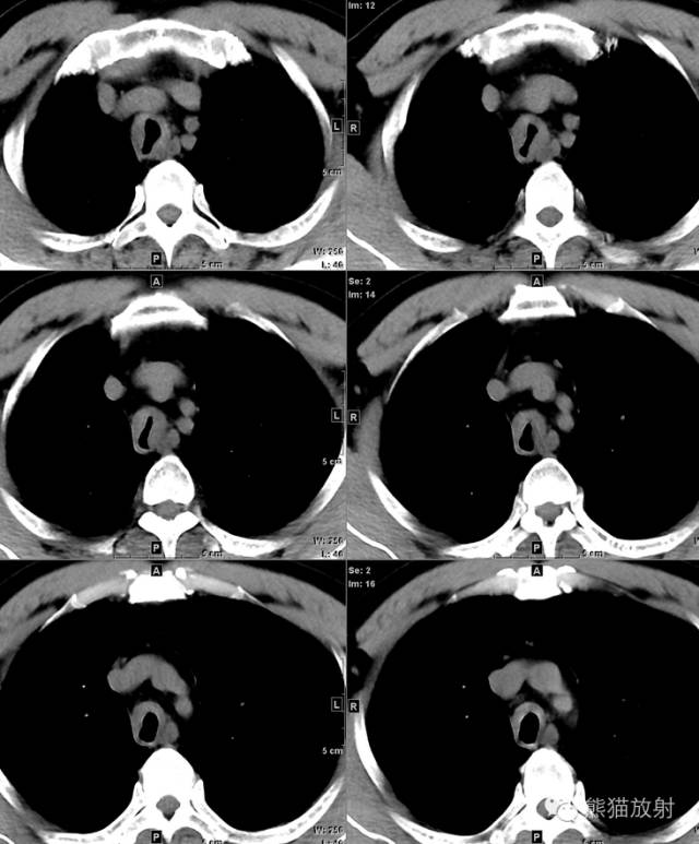【病例】气管腺样囊性癌1例CT影像表现 【病例】气管腺样囊性癌1例CT影像表现
