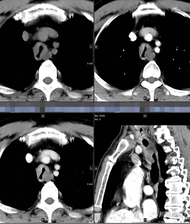 【病例】气管腺样囊性癌1例CT影像表现 【病例】气管腺样囊性癌1例CT影像表现