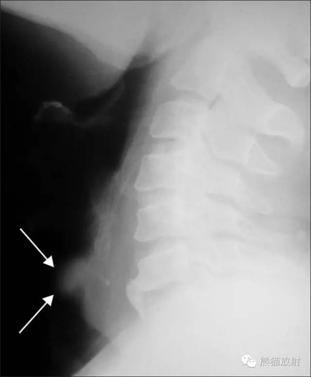 【病例】气管腺样囊性癌1例CT影像表现 【病例】气管腺样囊性癌1例CT影像表现
