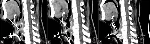 【病例】气管腺样囊性癌1例CT影像表现 【病例】气管腺样囊性癌1例CT影像表现