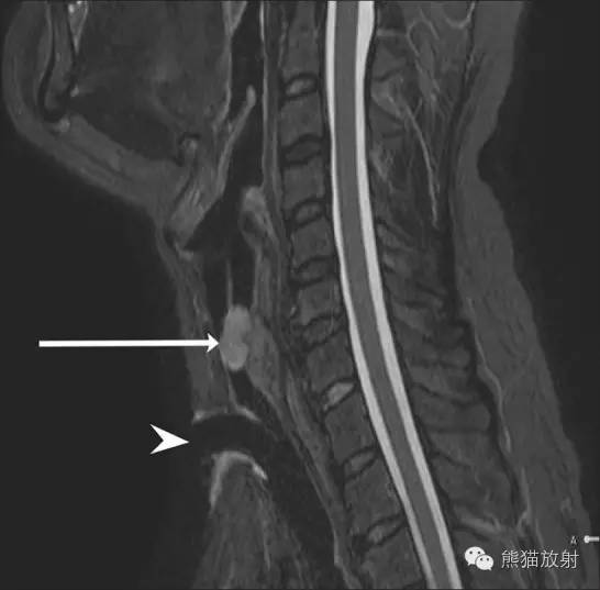 【病例】气管腺样囊性癌1例CT影像表现 【病例】气管腺样囊性癌1例CT影像表现