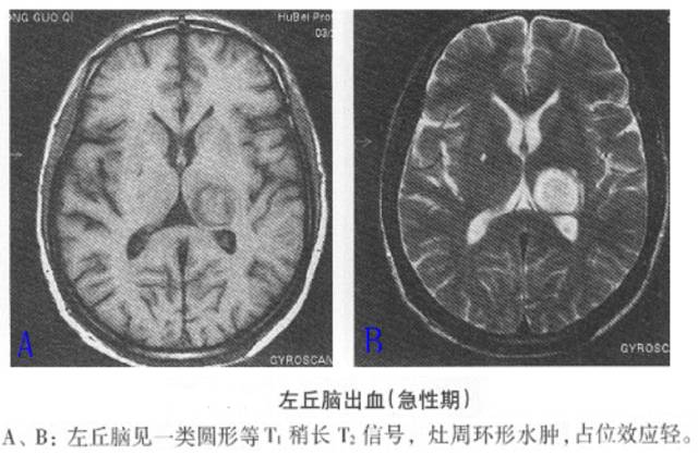 图文详解脑内血肿的分期