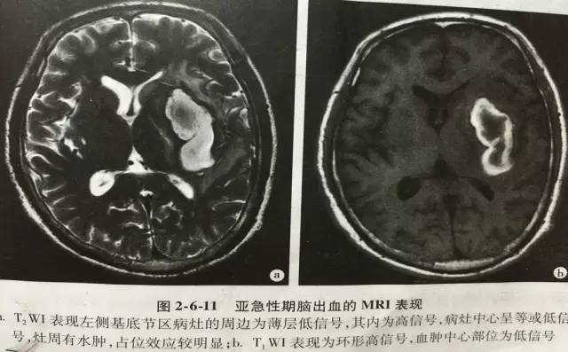 图文详解脑内血肿的分期