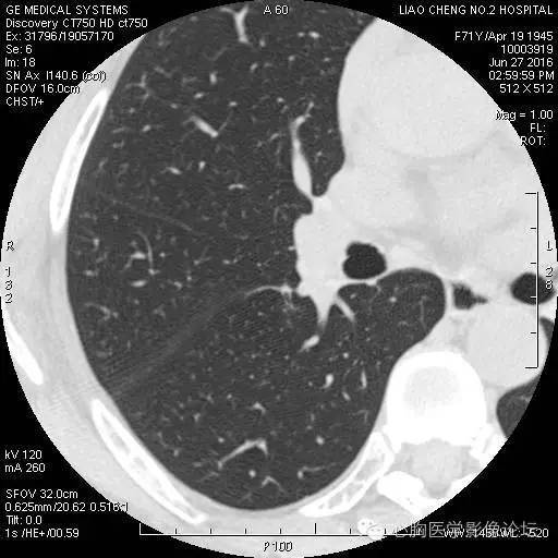 【病例】粘液型肺腺癌3例CT影像表现与分析 【病例】粘液型肺腺癌3例CT影像表现与分析
