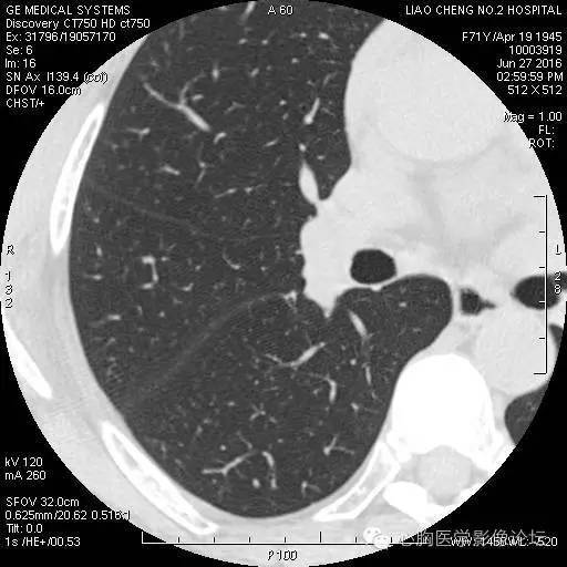 【病例】粘液型肺腺癌3例CT影像表现与分析 【病例】粘液型肺腺癌3例CT影像表现与分析