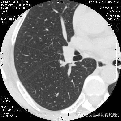 【病例】粘液型肺腺癌3例CT影像表现与分析 【病例】粘液型肺腺癌3例CT影像表现与分析