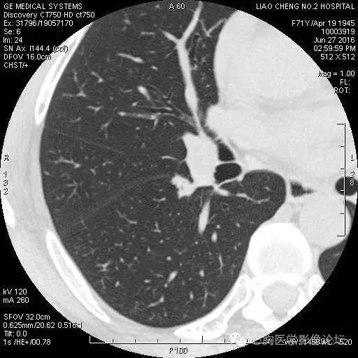 【病例】粘液型肺腺癌3例CT影像表现与分析 【病例】粘液型肺腺癌3例CT影像表现与分析