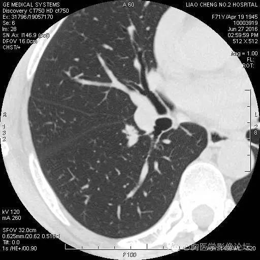 【病例】粘液型肺腺癌3例CT影像表现与分析