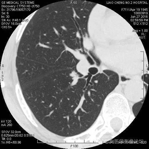 【病例】粘液型肺腺癌3例CT影像表现与分析 【病例】粘液型肺腺癌3例CT影像表现与分析