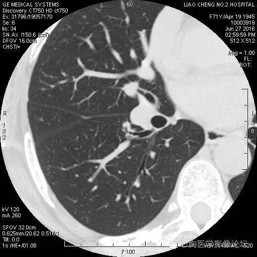 【病例】粘液型肺腺癌3例CT影像表现与分析 【病例】粘液型肺腺癌3例CT影像表现与分析