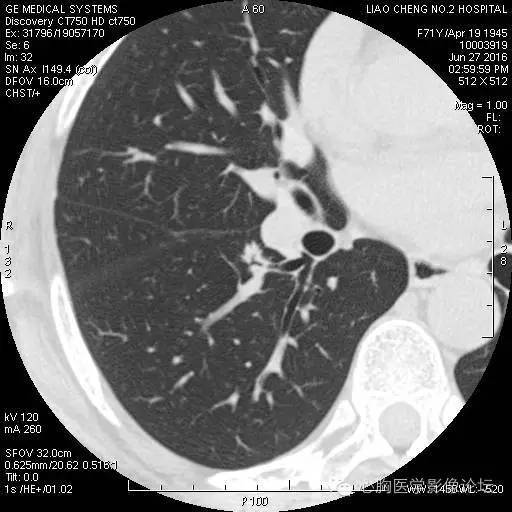 【病例】粘液型肺腺癌3例CT影像表现与分析 【病例】粘液型肺腺癌3例CT影像表现与分析