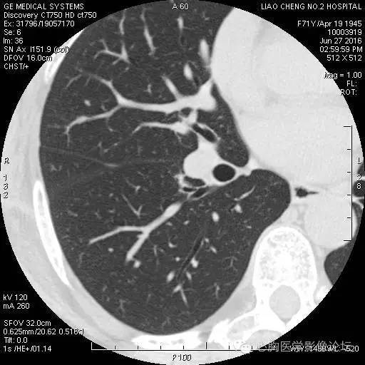 【病例】粘液型肺腺癌3例CT影像表现与分析 【病例】粘液型肺腺癌3例CT影像表现与分析