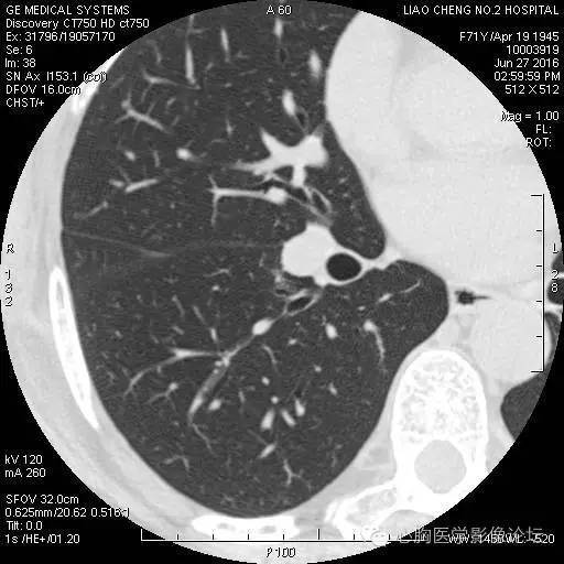 【病例】粘液型肺腺癌3例CT影像表现与分析 【病例】粘液型肺腺癌3例CT影像表现与分析