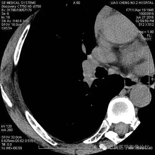 【病例】粘液型肺腺癌3例CT影像表现与分析 【病例】粘液型肺腺癌3例CT影像表现与分析