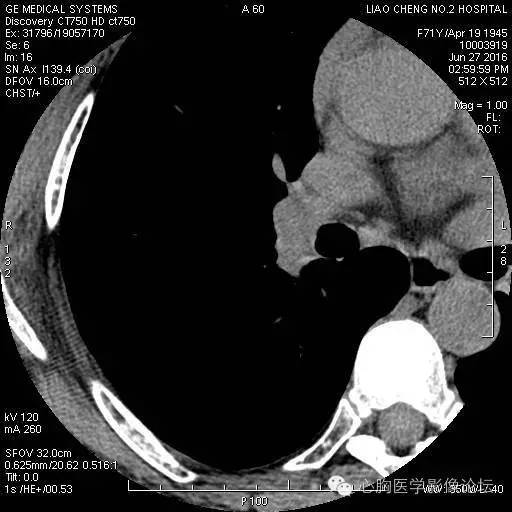 【病例】粘液型肺腺癌3例CT影像表现与分析 【病例】粘液型肺腺癌3例CT影像表现与分析