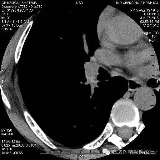 【病例】粘液型肺腺癌3例CT影像表现与分析 【病例】粘液型肺腺癌3例CT影像表现与分析