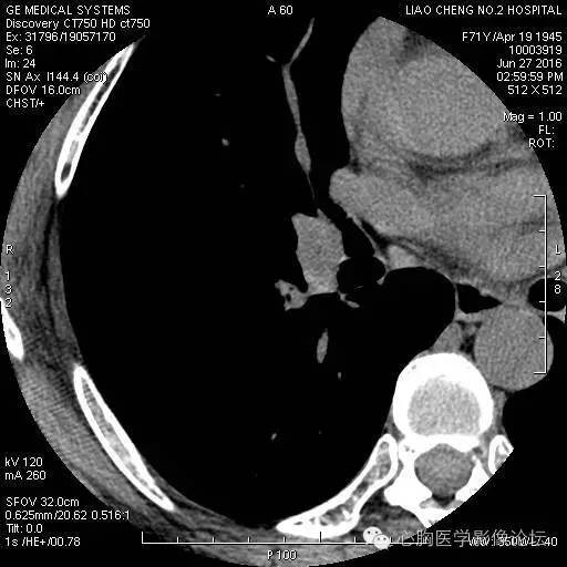 【病例】粘液型肺腺癌3例CT影像表现与分析 【病例】粘液型肺腺癌3例CT影像表现与分析