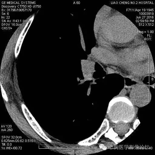 【病例】粘液型肺腺癌3例CT影像表现与分析 【病例】粘液型肺腺癌3例CT影像表现与分析