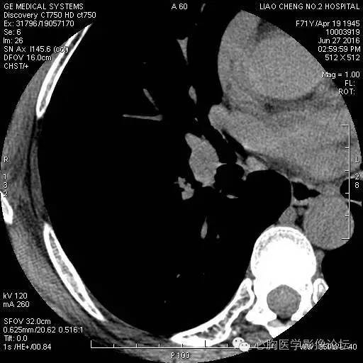 【病例】粘液型肺腺癌3例CT影像表现与分析 【病例】粘液型肺腺癌3例CT影像表现与分析