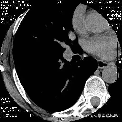 【病例】粘液型肺腺癌3例CT影像表现与分析 【病例】粘液型肺腺癌3例CT影像表现与分析