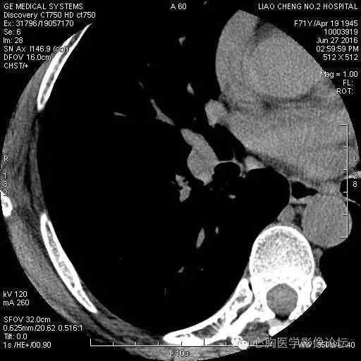 【病例】粘液型肺腺癌3例CT影像表现与分析 【病例】粘液型肺腺癌3例CT影像表现与分析