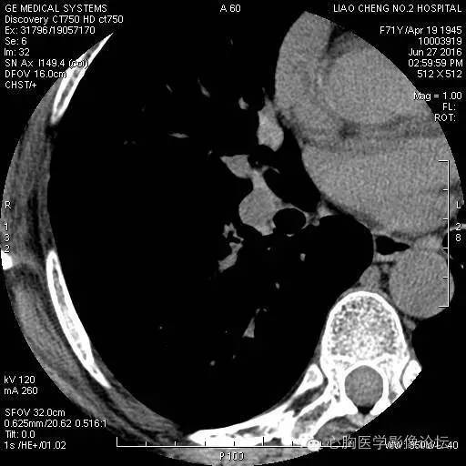 【病例】粘液型肺腺癌3例CT影像表现与分析 【病例】粘液型肺腺癌3例CT影像表现与分析