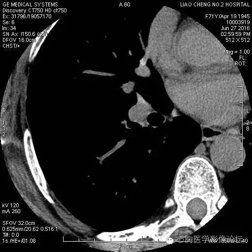 【病例】粘液型肺腺癌3例CT影像表现与分析 【病例】粘液型肺腺癌3例CT影像表现与分析