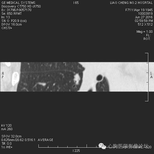 【病例】粘液型肺腺癌3例CT影像表现与分析 【病例】粘液型肺腺癌3例CT影像表现与分析