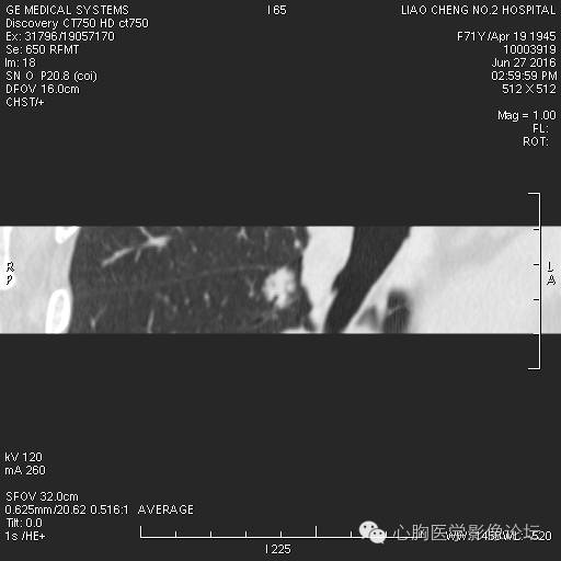 【病例】粘液型肺腺癌3例CT影像表现与分析 【病例】粘液型肺腺癌3例CT影像表现与分析