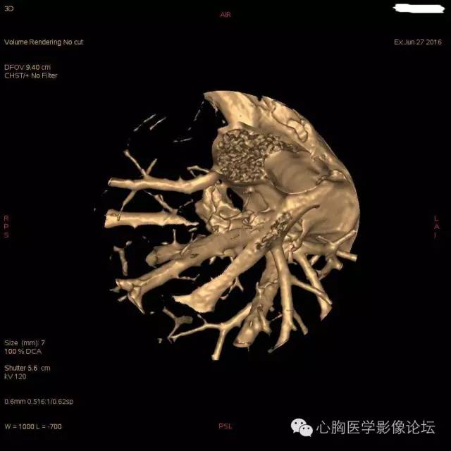 【病例】粘液型肺腺癌3例CT影像表现与分析 【病例】粘液型肺腺癌3例CT影像表现与分析