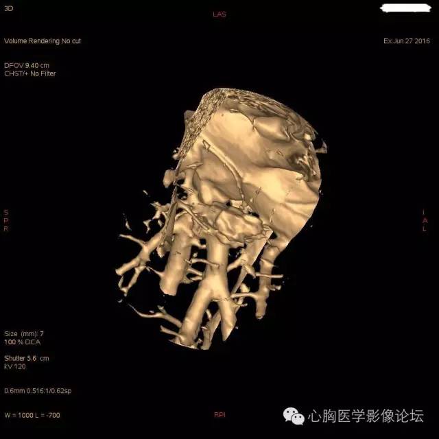 【病例】粘液型肺腺癌3例CT影像表现与分析 【病例】粘液型肺腺癌3例CT影像表现与分析