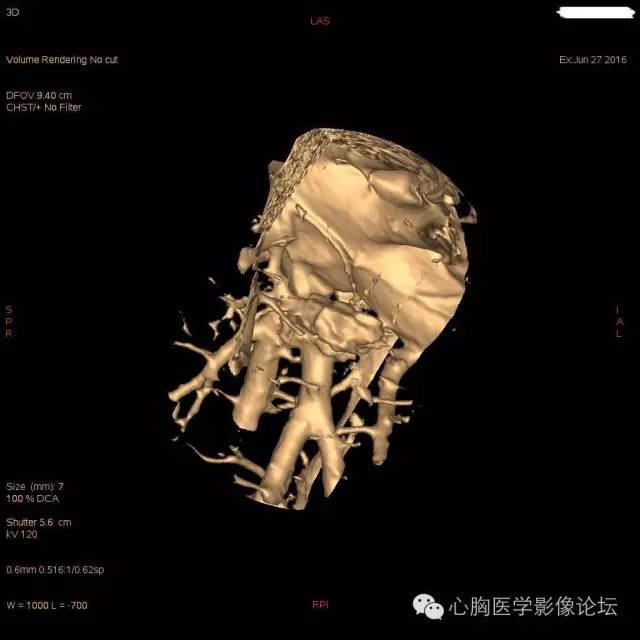 【病例】粘液型肺腺癌3例CT影像表现与分析 【病例】粘液型肺腺癌3例CT影像表现与分析