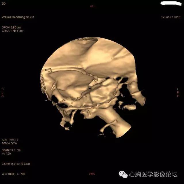 【病例】粘液型肺腺癌3例CT影像表现与分析 【病例】粘液型肺腺癌3例CT影像表现与分析