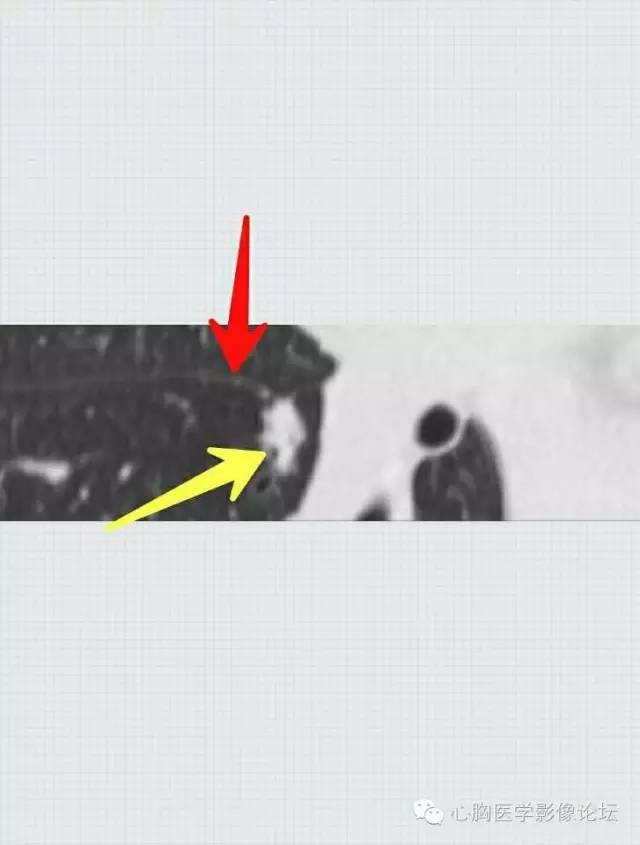 【病例】粘液型肺腺癌3例CT影像表现与分析 【病例】粘液型肺腺癌3例CT影像表现与分析